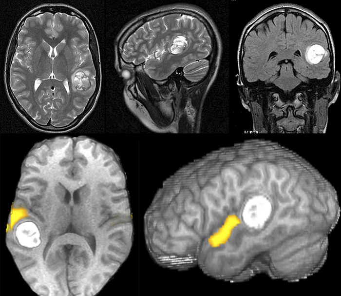Патологии на мрт. Функциональная магнитно-резонансная томография головного мозга. Кт томограмма головного мозга. Мрт и ФМРТ. Функциональное мрт головного мозга.
